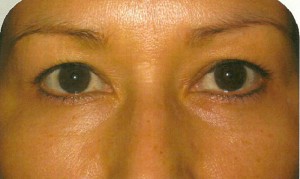 Eyelid Lift Case 3654 Before Photo Eyelid Lift