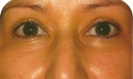 Eyelid Lift