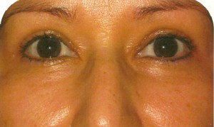 Eyelid Lift Case 3654 After Photo Eyelid Lift