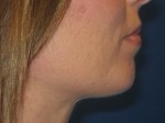 Chin Implant