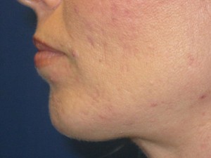 Chin Implant