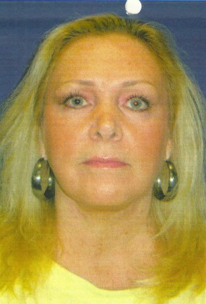 FACEology Lift / Neck Lift Case 3683 After Photo FACEology Lift / Neck Lift