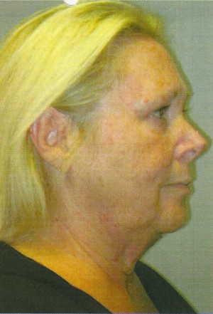 FACEology Lift / Neck Lift Case 3683 Before Photo FACEology Lift / Neck Lift