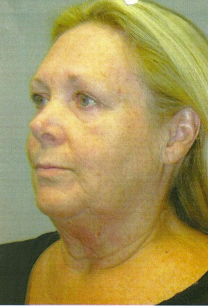 FACEology Lift / Neck Lift Case 3683 Before Photo FACEology Lift / Neck Lift