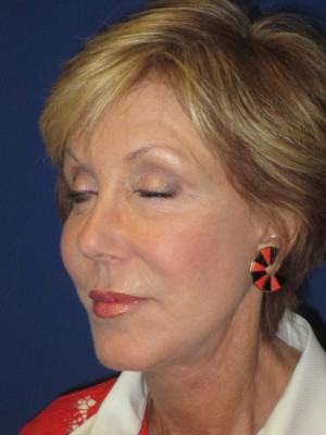 FACEology Lift / Neck Lift Case 3700 After Photo FACEology Lift / Neck Lift