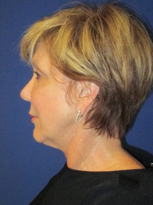 FACEology Lift / Neck Lift Case 3700 Before Photo FACEology Lift / Neck Lift