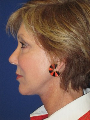 FACEology Lift / Neck Lift Case 3700 After Photo FACEology Lift / Neck Lift