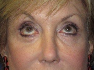 FACEology Lift / Neck Lift Case 3700 After Photo FACEology Lift / Neck Lift