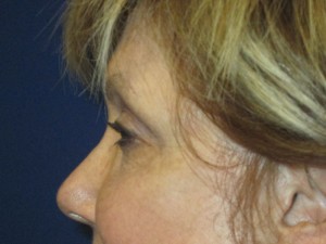 FACEology Lift / Neck Lift Case 3700 Before Photo FACEology Lift / Neck Lift