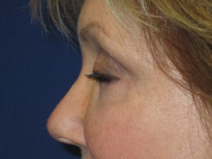 FACEology Lift / Neck Lift Case 3700 After Photo FACEology Lift / Neck Lift