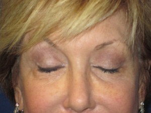 FACEology Lift / Neck Lift Case 3700 Before Photo FACEology Lift / Neck Lift