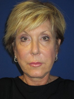 FACEology Lift / Neck Lift Case 3700 Before Photo FACEology Lift / Neck Lift