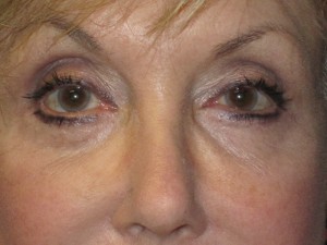 FACEology Lift / Neck Lift Case 3700 After Photo FACEology Lift / Neck Lift