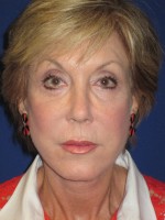 FACEology Lift / Neck Lift