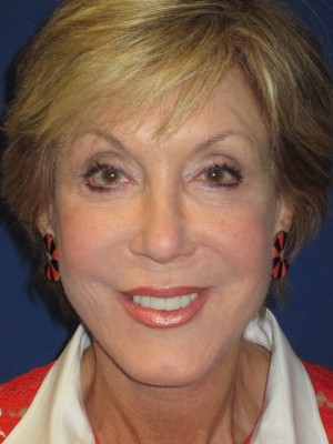 FACEology Lift / Neck Lift Case 3700 After Photo FACEology Lift / Neck Lift
