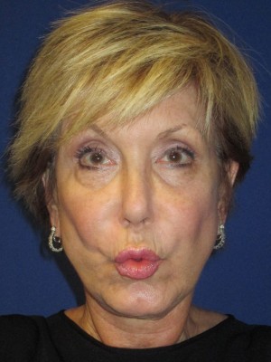 FACEology Lift / Neck Lift Case 3700 Before Photo FACEology Lift / Neck Lift