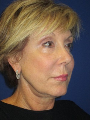 FACEology Lift / Neck Lift Case 3700 Before Photo FACEology Lift / Neck Lift