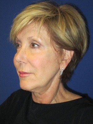 FACEology Lift / Neck Lift Case 3700 Before Photo FACEology Lift / Neck Lift