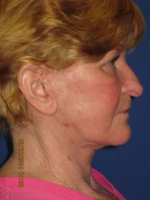 FACEology Lift / Neck Lift Case 3726 After Photo FACEology Lift / Neck Lift