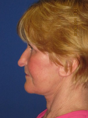 FACEology Lift / Neck Lift Case 3726 After Photo FACEology Lift / Neck Lift