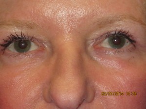 FACEology Lift / Neck Lift Case 3726 After Photo FACEology Lift / Neck Lift