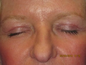 FACEology Lift / Neck Lift Case 3726 After Photo FACEology Lift / Neck Lift