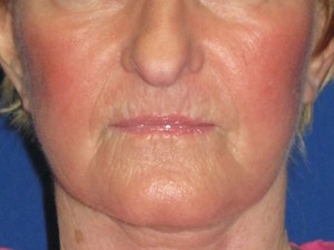 FACEology Lift / Neck Lift Case 3726 After Photo FACEology Lift / Neck Lift