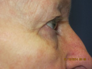 FACEology Lift / Neck Lift Case 3726 Before Photo FACEology Lift / Neck Lift