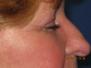 FACEology Lift / Neck Lift Case 3726 After Photo FACEology Lift / Neck Lift