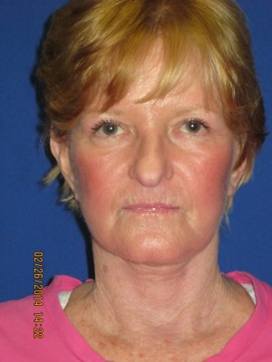 FACEology Lift / Neck Lift Case 3726 After Photo FACEology Lift / Neck Lift