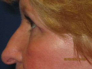 FACEology Lift / Neck Lift Case 3726 After Photo FACEology Lift / Neck Lift
