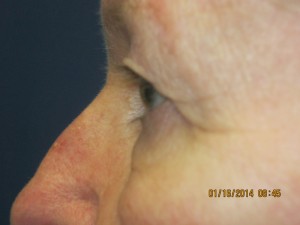 FACEology Lift / Neck Lift Case 3726 Before Photo FACEology Lift / Neck Lift