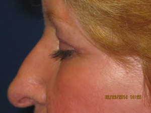 FACEology Lift / Neck Lift Case 3726 After Photo FACEology Lift / Neck Lift