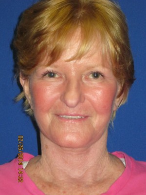 FACEology Lift / Neck Lift Case 3726 After Photo FACEology Lift / Neck Lift