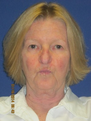 FACEology Lift / Neck Lift Case 3726 Before Photo FACEology Lift / Neck Lift