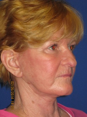 FACEology Lift / Neck Lift Case 3726 After Photo FACEology Lift / Neck Lift