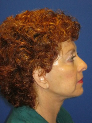 FACEology Lift / Neck Lift