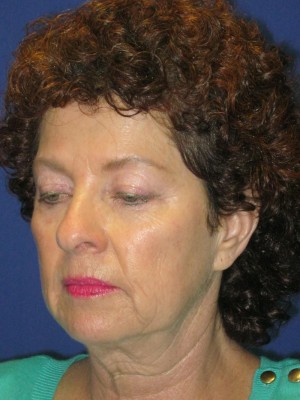 FACEology Lift / Neck Lift