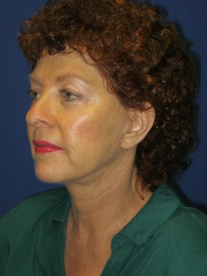 FACEology Lift / Neck Lift