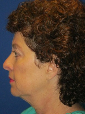 FACEology Lift / Neck Lift