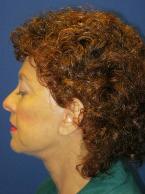 FACEology Lift / Neck Lift