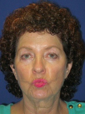 FACEology Lift / Neck Lift