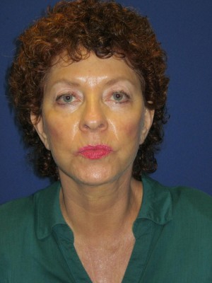 FACEology Lift / Neck Lift