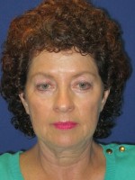 FACEology Lift / Neck Lift