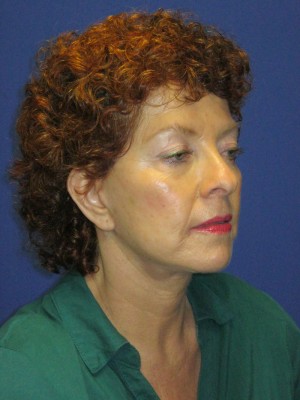 FACEology Lift / Neck Lift