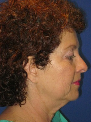 FACEology Lift / Neck Lift