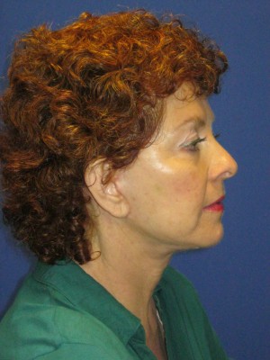 FACEology Lift / Neck Lift