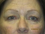 Eyelid Lift