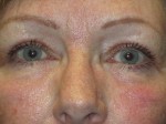 Eyelid Lift