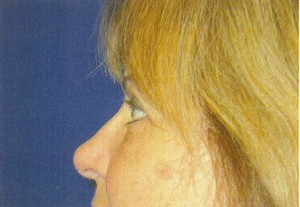 Eyelid Lift Case 3935 After Photo Eyelid Lift